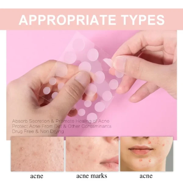 WestMonth Acne Patch Repair Acne Pimples Acne Invisible Concealer Breathable Acne Patch - Image 3