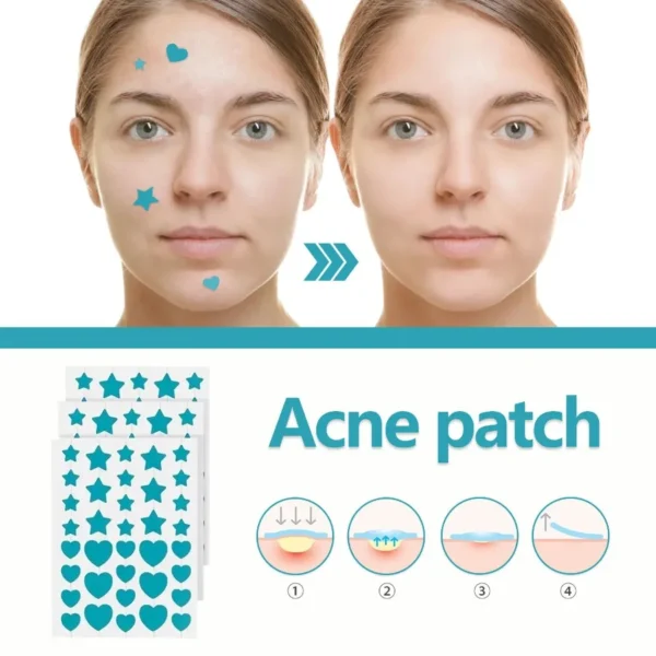 WestMonth Hydrocolloidal Acne Patch Repair Acne Acne Cleansing Invisible Breathable Waterproof Acne Cleansing Concealer - Image 3